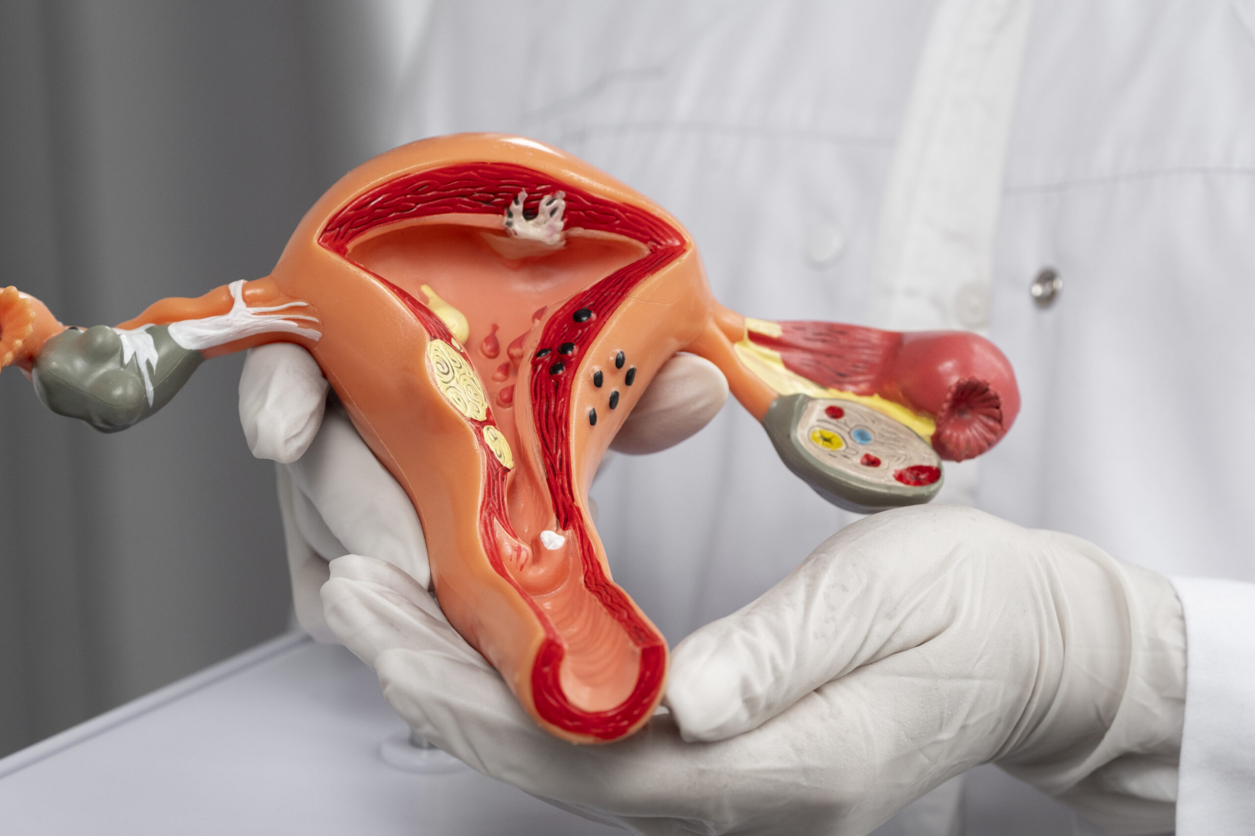 Cervical Cancer Treatment treatment