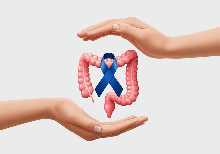 Colorectal Cancer Treatment treatment