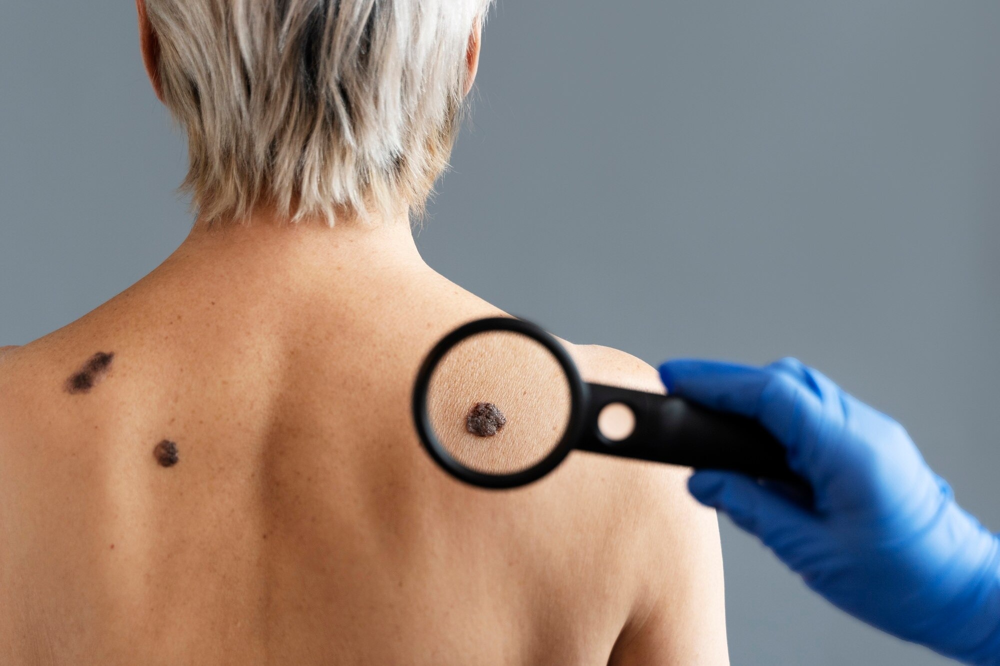 Skin Cancer Treatment