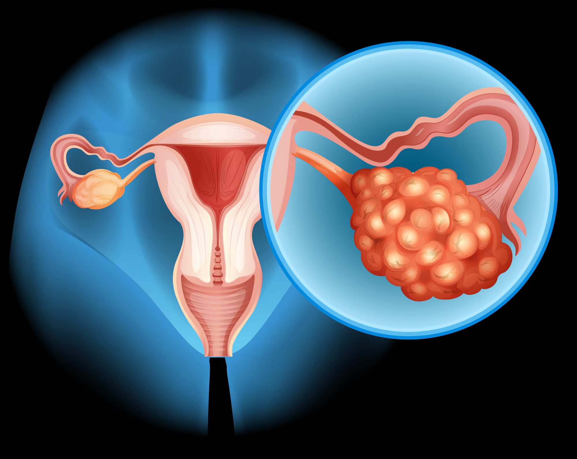 Ovarian Cancer Treatment treatment