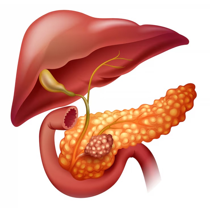 Pancreatic Cancer Treatment treatment
