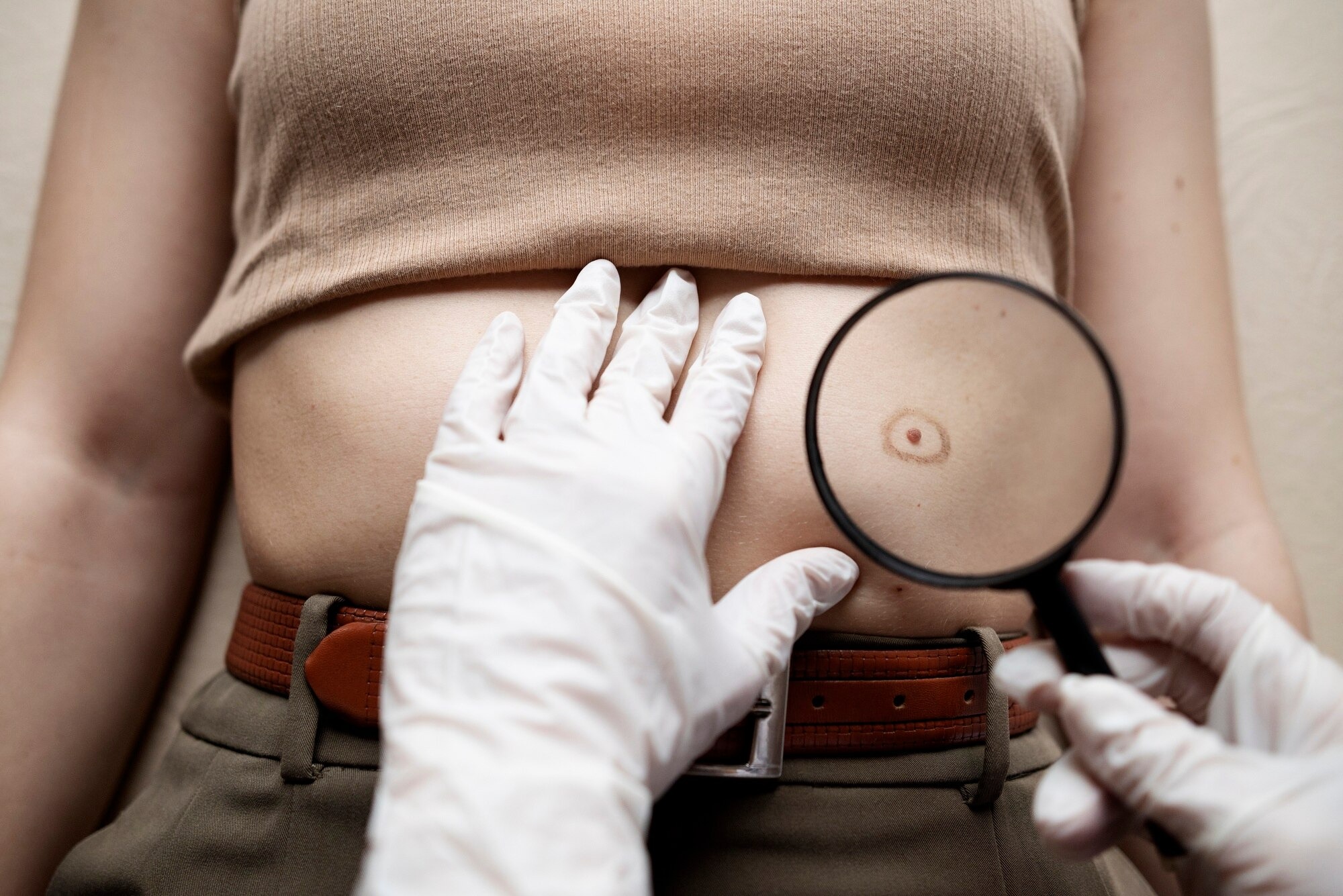 Skin Cancer Treatment treatment