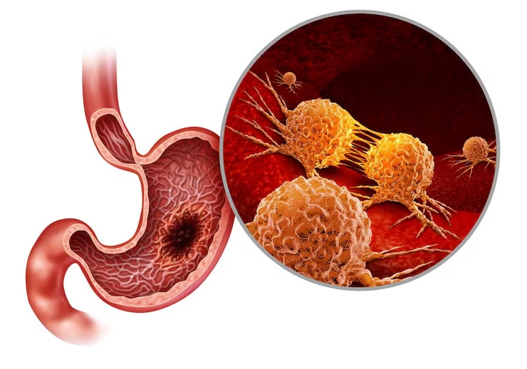 Stomach Cancer Treatment treatment