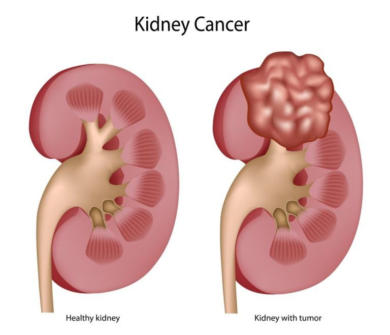 Understanding Renal Tumor Symptoms