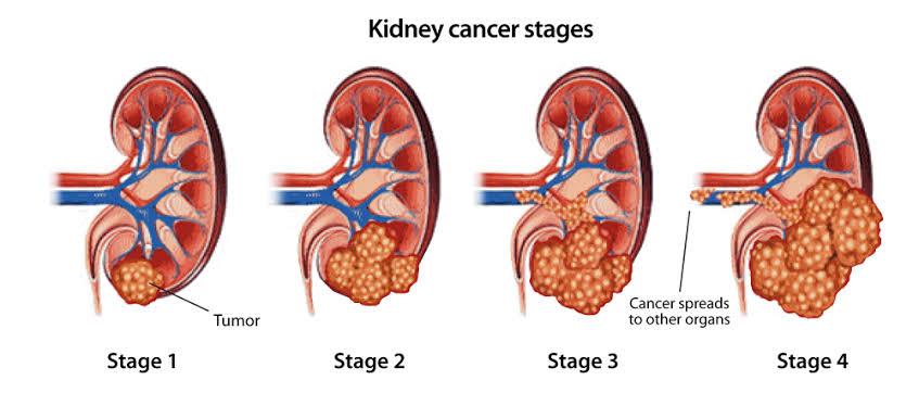 Advanced Disease